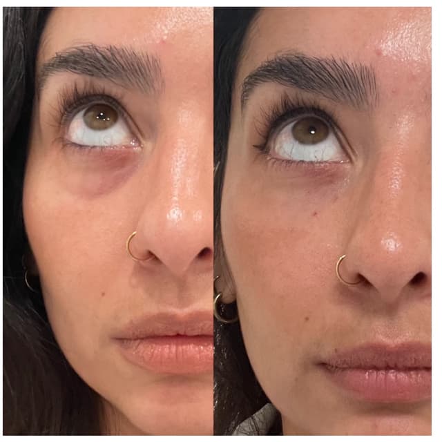 PRFM - Undereyes Series (3) at Aesthetic Connection Medspa in Rancho Cucamonga, CA